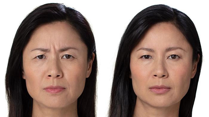 BOTOX® Cosmetic Case 10 Before & After Front | Houston, TX | DermSurgery Associates