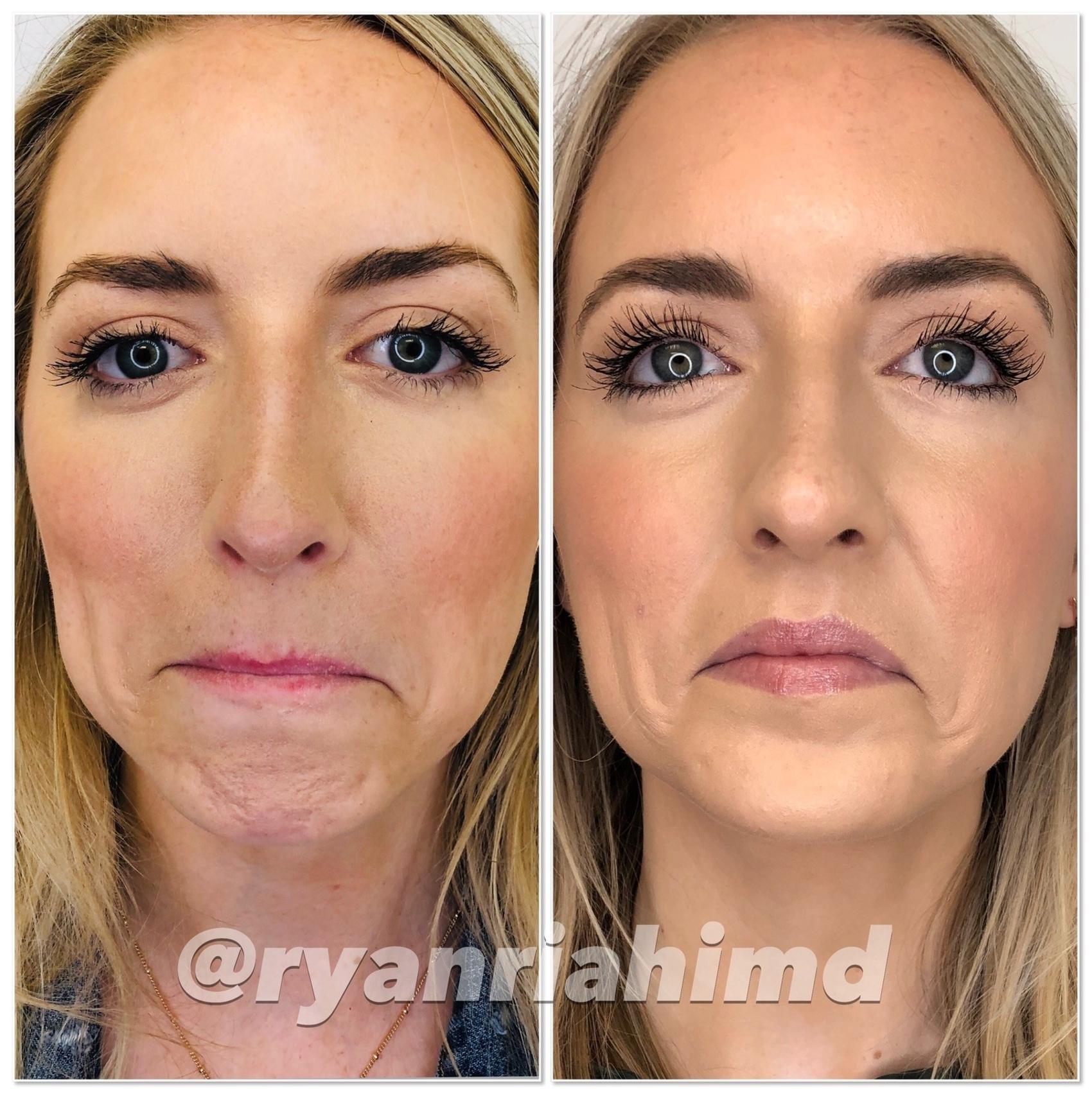BOTOX® Cosmetic Case 45 Before & After Front | Houston, TX | DermSurgery Associates