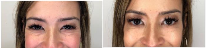 BOTOX® Cosmetic Case 50 Before & After Front | Houston, TX | DermSurgery Associates