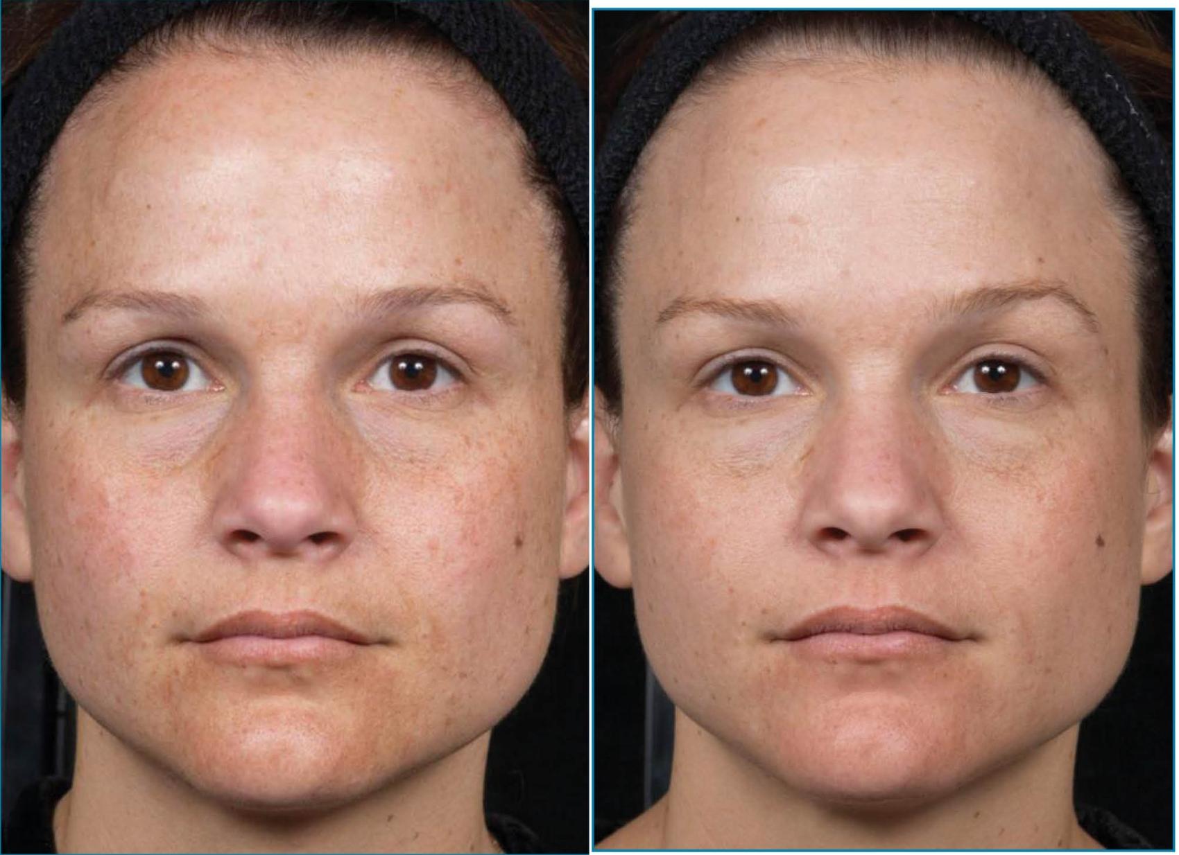 Clear + Brilliant Laser Treatment by a Greater Houston, TX, Dermatologist