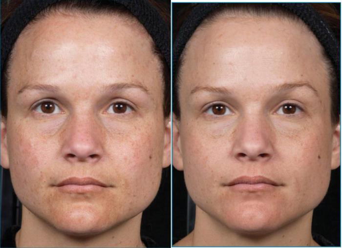 Clear + Brilliant Case 23 Before & After Front | Houston, TX | DermSurgery Associates