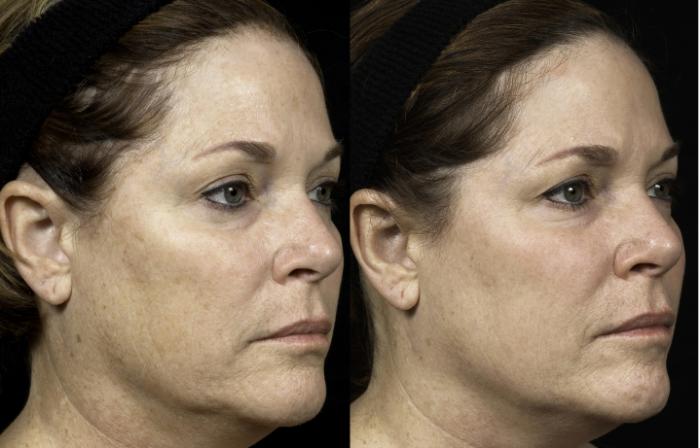 Fraxel® Case 4 Before & After Right Oblique | Houston, TX | DermSurgery Associates