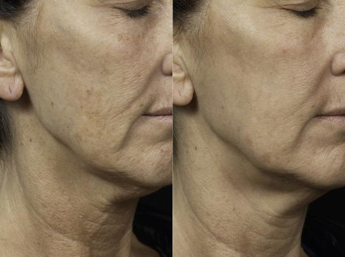 Fraxel® Case 5 Before & After Right Oblique | Houston, TX | DermSurgery Associates