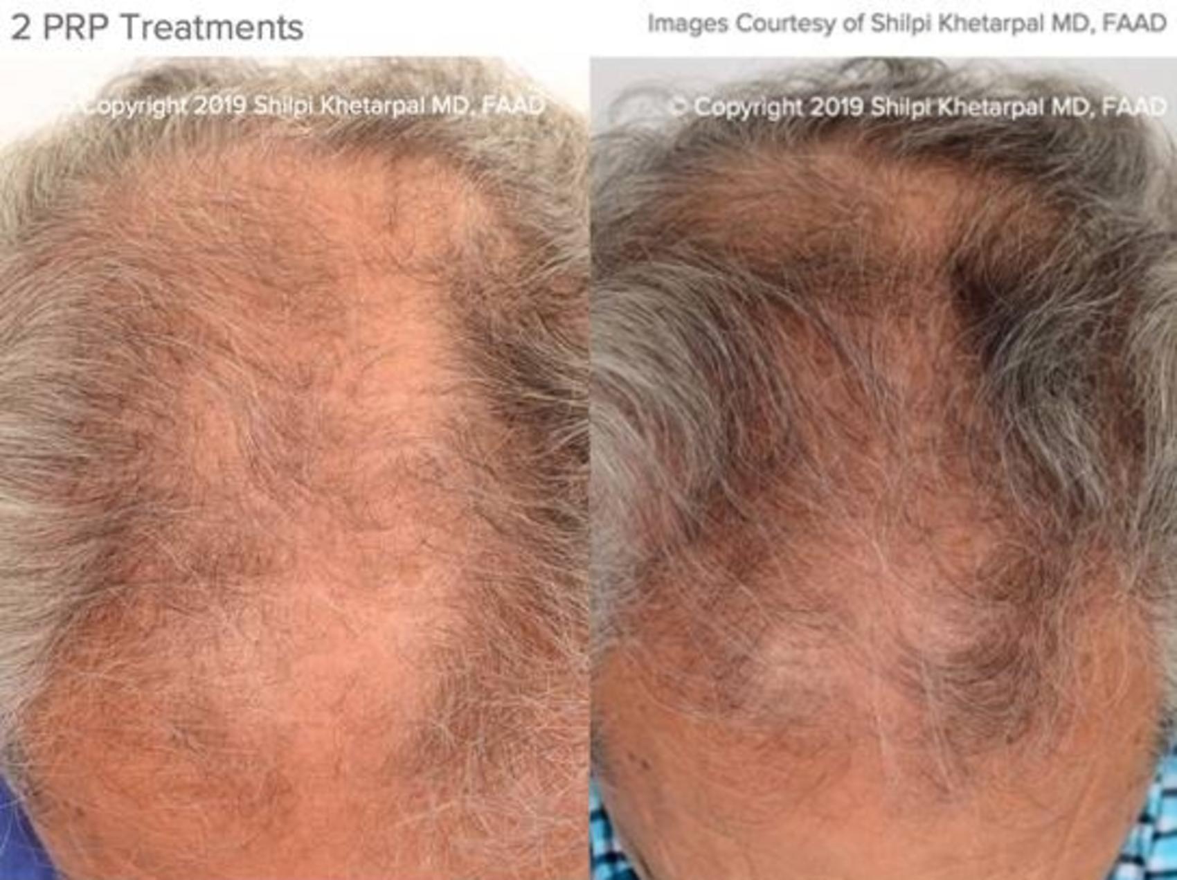 Hair Restoration Case 12 Before & After Top of Head Front | Houston, TX | DermSurgery Associates