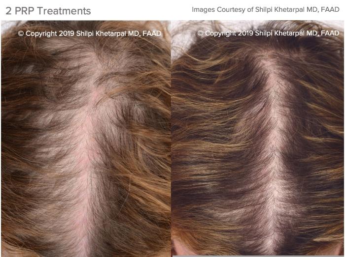 Hair Restoration Case 13 Before & After Top of Head Front | Houston, TX | DermSurgery Associates