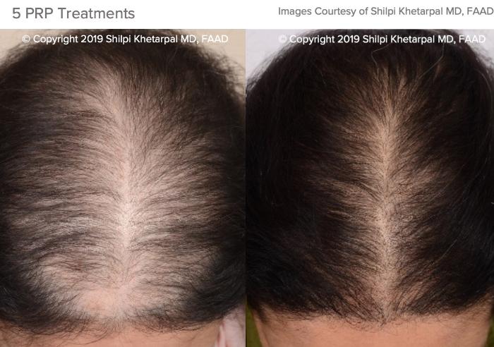 Hair Restoration Case 14 Before & After Top of Head Front | Houston, TX | DermSurgery Associates