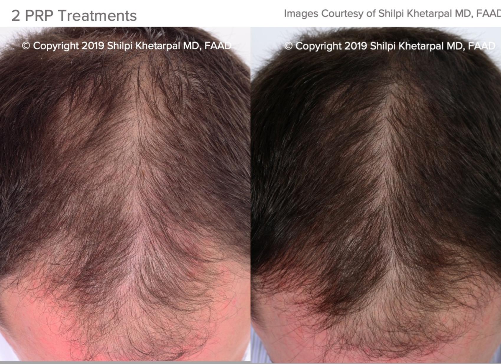 Hair Loss Treatment In Greater Houston Tx Dermsurgery Associates