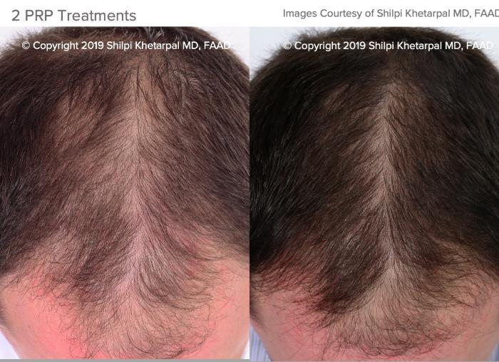Hair Restoration Case 15 Before & After Top of Head Front | Houston, TX | DermSurgery Associates