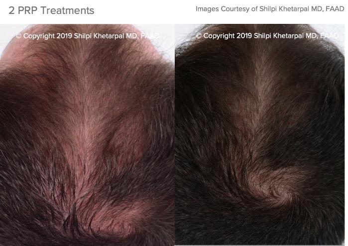 Hair Restoration Case 16 Before & After Top of Head Front | Houston, TX | DermSurgery Associates