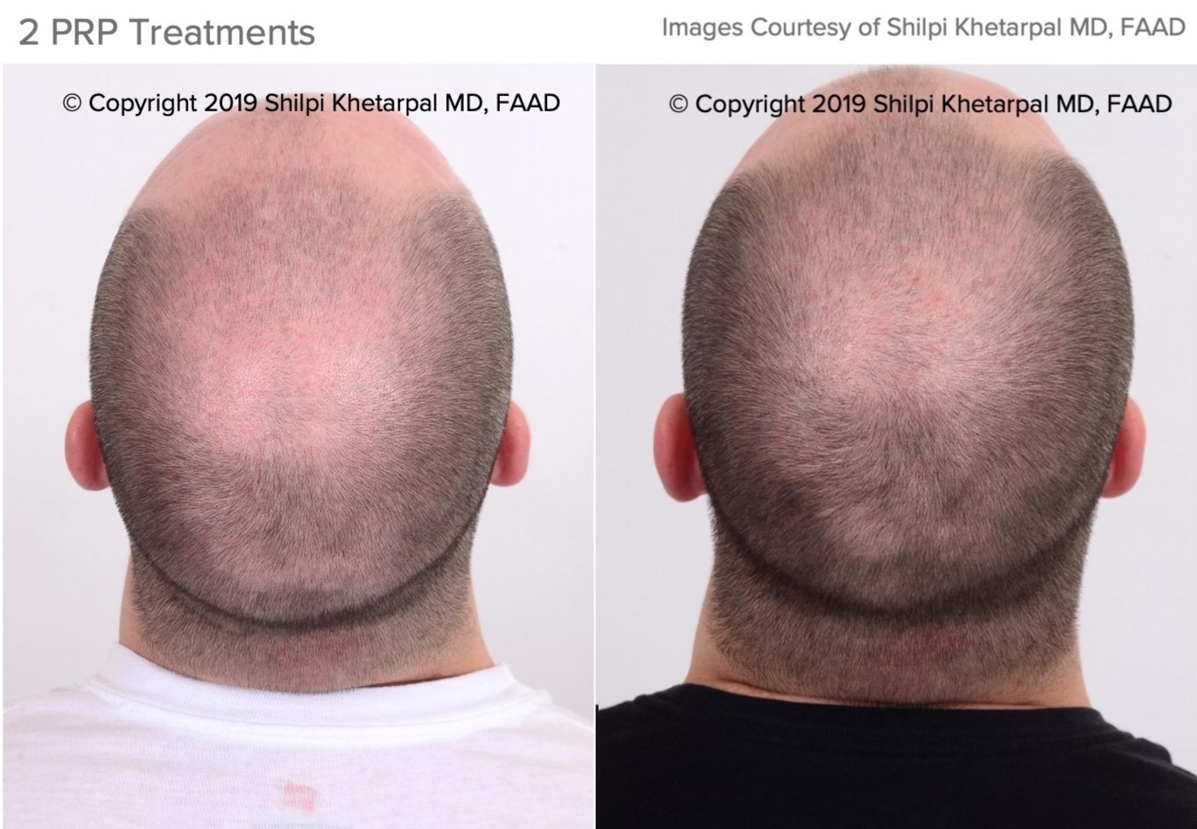 Hair Loss Treatment In Greater Houston Tx Dermsurgery Associates