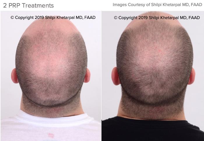 Hair Restoration Case 17 Before & After Top of Head Back | Houston, TX | DermSurgery Associates