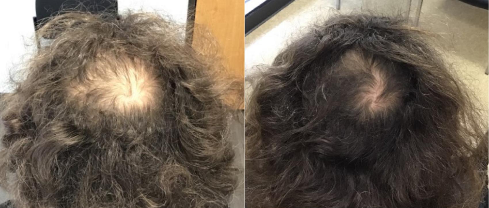 Hair Restoration Before & After Photos Patient 42 | Houston, TX |  DermSurgery Associates