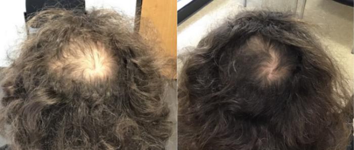 Hair Restoration Case 42 Before & After Back | Houston, TX | DermSurgery Associates