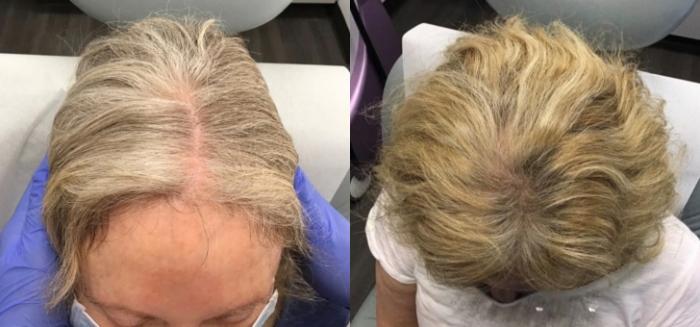 Hair Restoration Case 44 Before & After Top of Head 4 Months After | Houston, TX | DermSurgery Associates