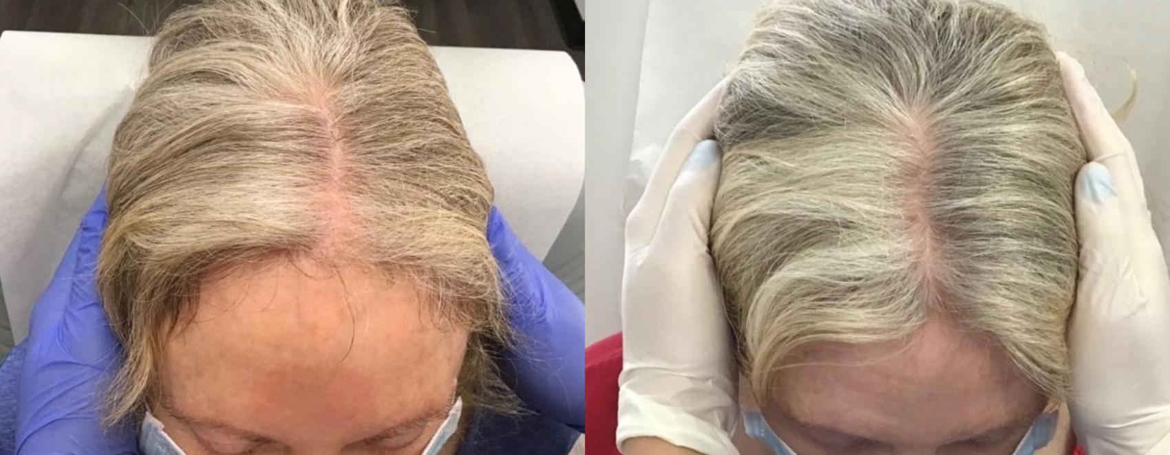 Hair Restoration Case 44 Before & After Top of Head | Houston, TX | DermSurgery Associates