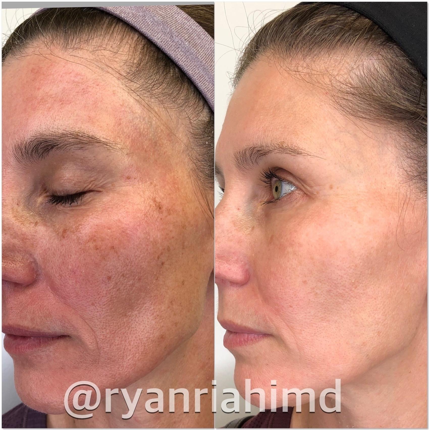 Intense Pulsed Light (IPL) Case 48 Before & After Right Side | Houston, TX | DermSurgery Associates