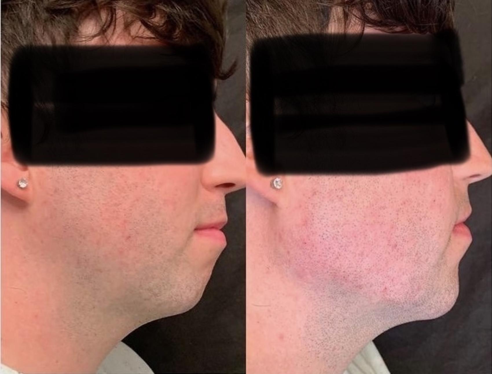 Jawline Filler Case 56 Before & After Right Side | Houston, TX | DermSurgery Associates