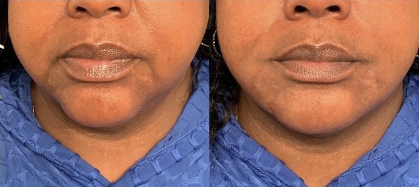 Jawline Filler Case 57 Before & After Front | Houston, TX | DermSurgery Associates