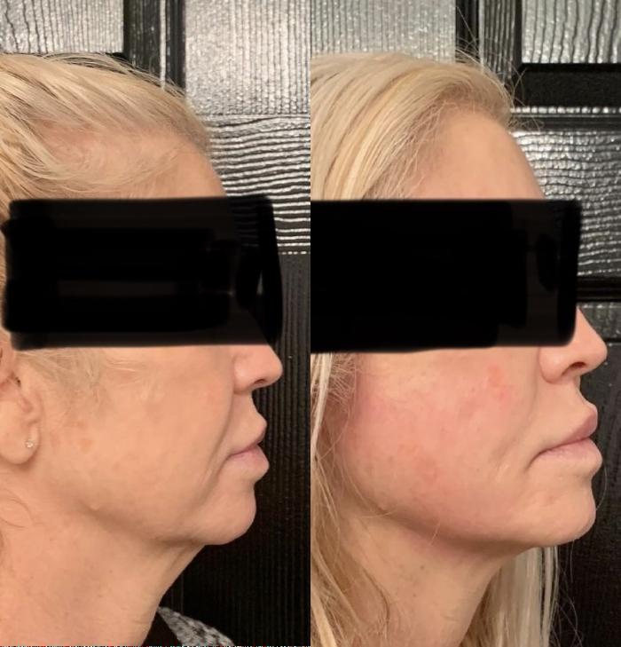 Jawline Filler Case 59 Before & After Right Side | Houston, TX | DermSurgery Associates
