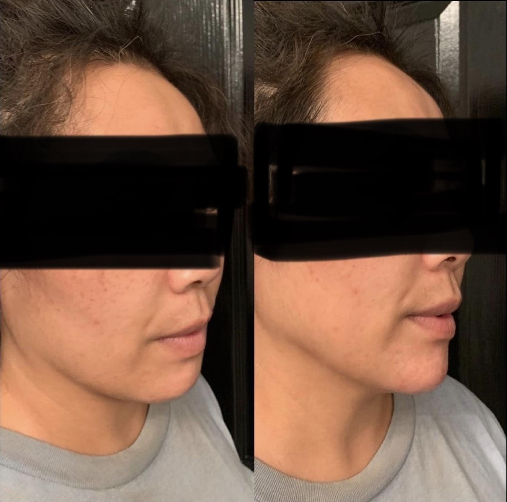 Jawline Filler Case 60 Before & After Right Oblique | Houston, TX | DermSurgery Associates
