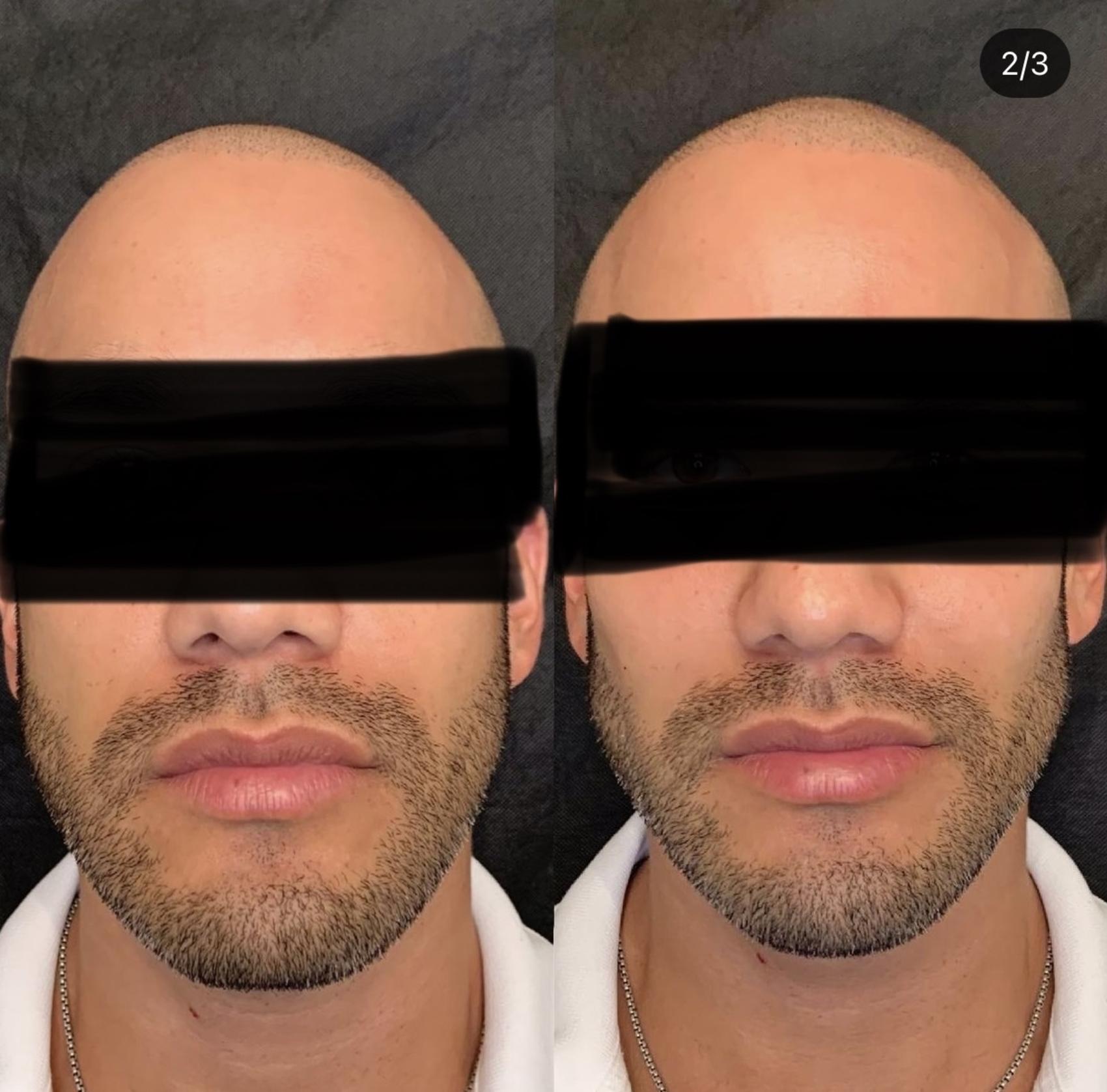 Jawline Filler Case 61 Before & After Front | Houston, TX | DermSurgery Associates