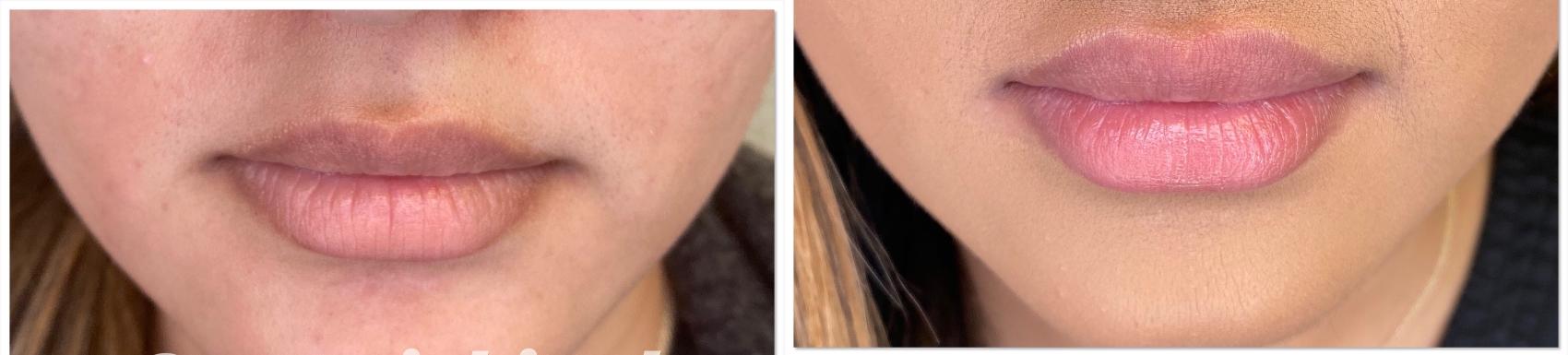 JUVÉDERM® Case 49 Before & After Front | Houston, TX | DermSurgery Associates