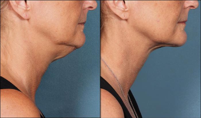 KYBELLA® Case 2 Before & After Right Side | Houston, TX | DermSurgery Associates