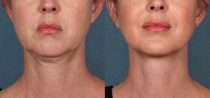 KYBELLA® Case 3 Before & After Front | Houston, TX | DermSurgery Associates