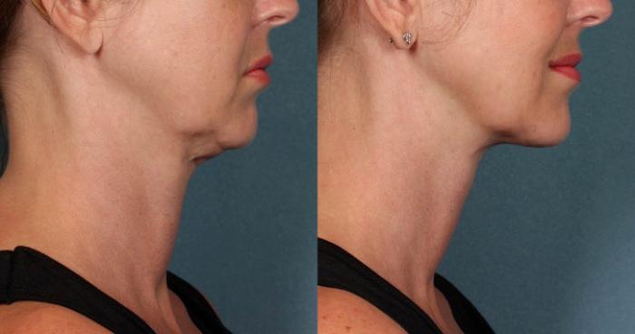 KYBELLA® Case 3 Before & After Right Side | Houston, TX | DermSurgery Associates