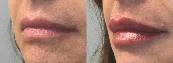 Lip Filler Case 68 Before & After Left Oblique | Houston, TX | DermSurgery Associates