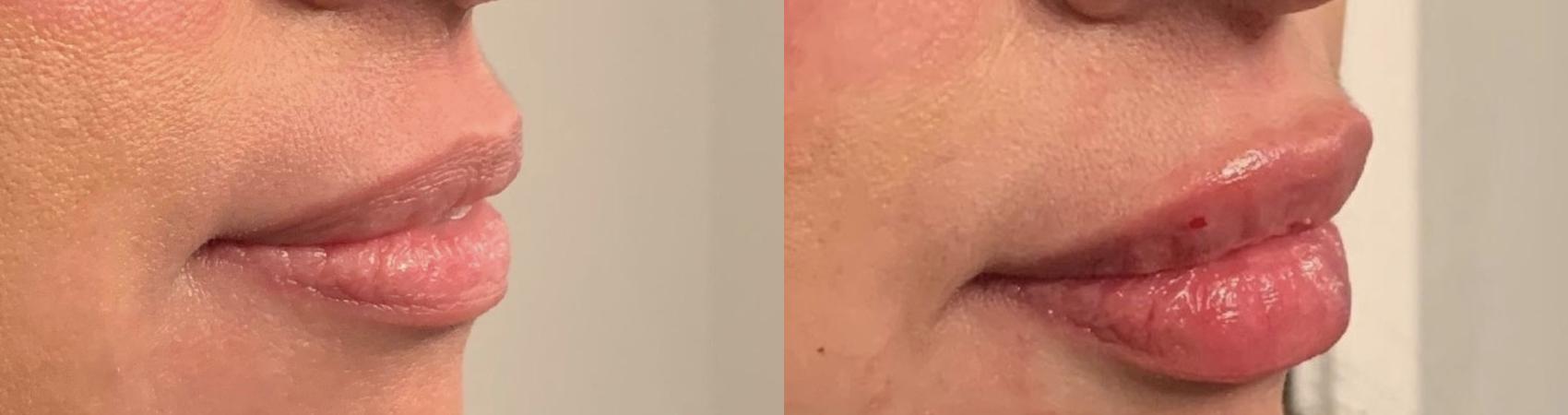 Lip Filler Case 69 Before & After Right Oblique | Houston, TX | DermSurgery Associates