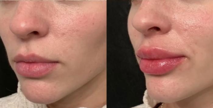 Lip Filler Case 70 Before & After Left Oblique | Houston, TX | DermSurgery Associates