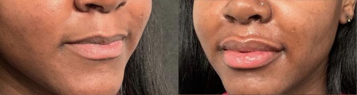 Lip Filler Case 73 Before & After Front | Houston, TX | DermSurgery Associates