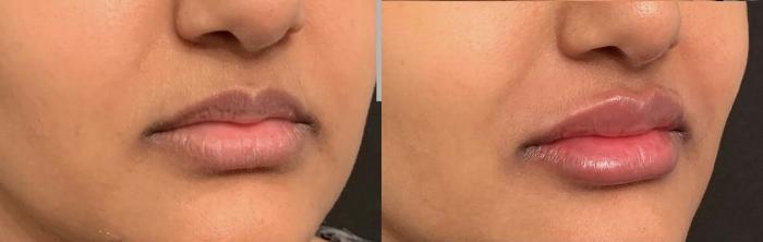 Lip Filler Case 75 Before & After Right Oblique | Houston, TX | DermSurgery Associates