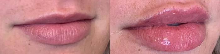 Lip Filler Case 80 Before & After Right Oblique | Houston, TX | DermSurgery Associates
