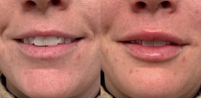 Lip Filler Case 81 Before & After Front | Houston, TX | DermSurgery Associates