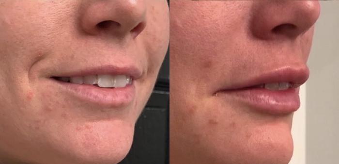 Lip Filler Case 81 Before & After Right Oblique | Houston, TX | DermSurgery Associates