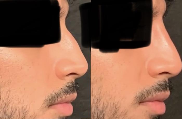 Nonsurgical Rhinoplasty Case 64 Before & After Right Side | Houston, TX | DermSurgery Associates