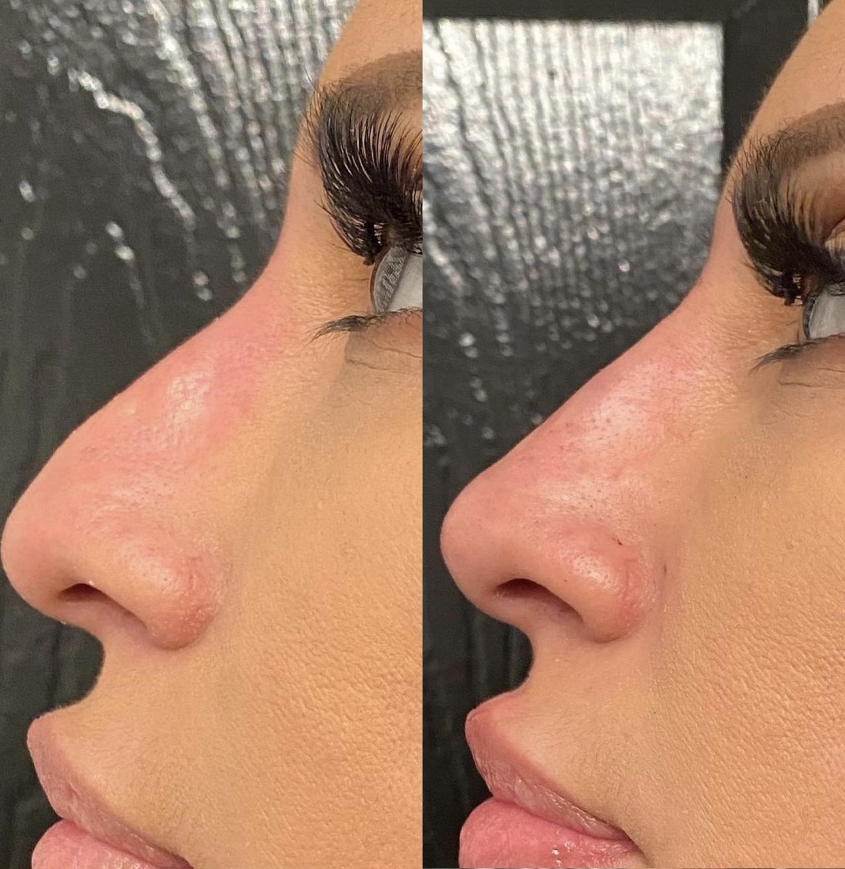 Nonsurgical Rhinoplasty Case 65 Before & After Right Side | Houston, TX | DermSurgery Associates