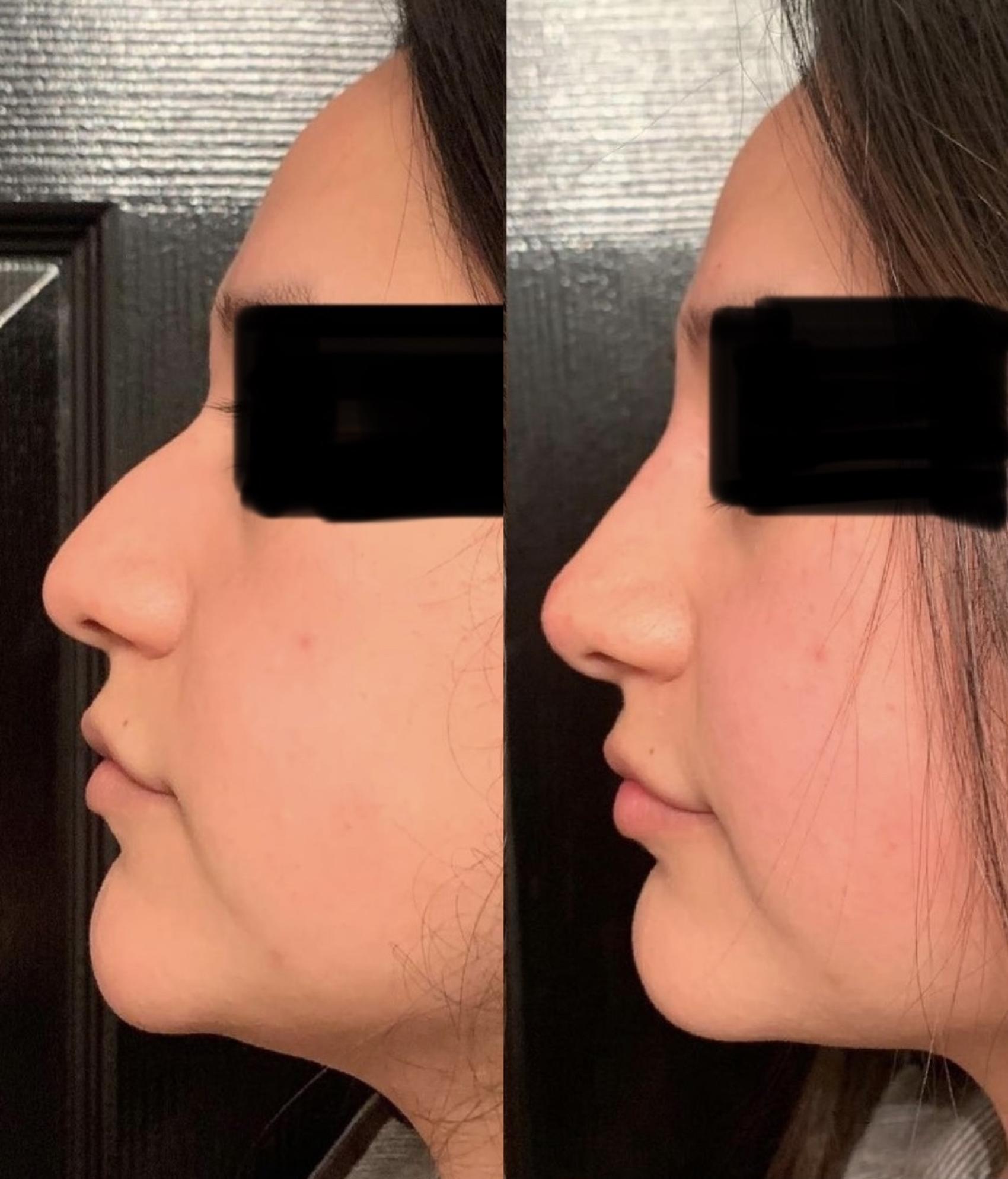 Nonsurgical Rhinoplasty Case 66 Before & After Left Side | Houston, TX | DermSurgery Associates