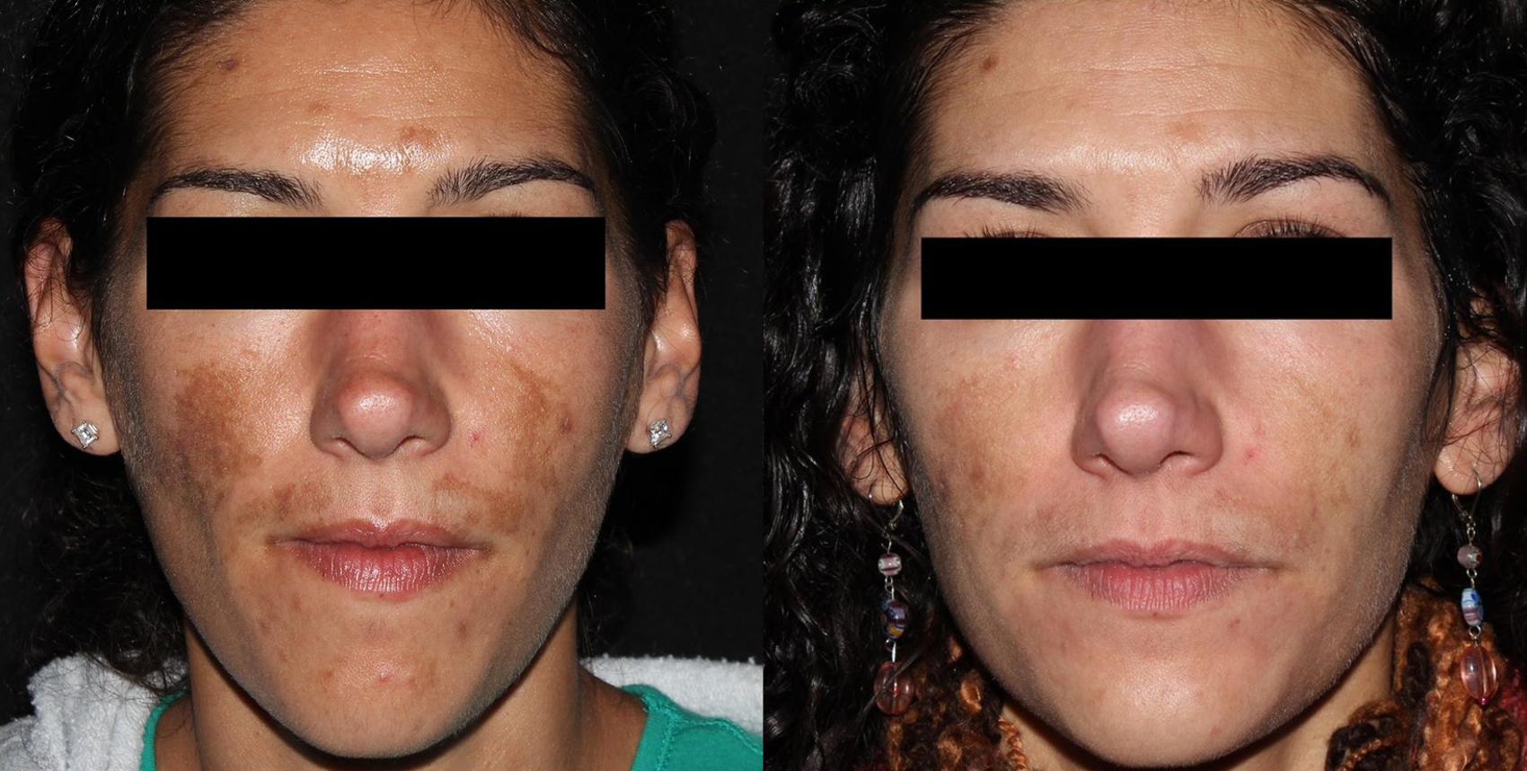 PicoSure Case 1 Before & After Front | Houston, TX | DermSurgery Associates