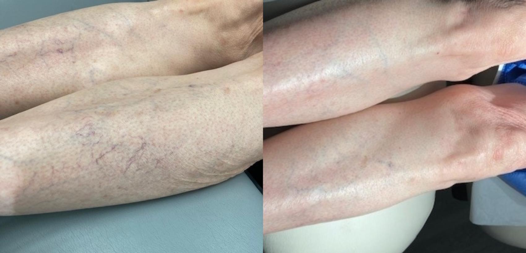 Sclerotherapy & Laser Vein Treatment Case 51 Before & After Front | Houston, TX | DermSurgery Associates