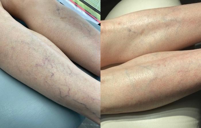 Sclerotherapy & Laser Vein Treatment Case 51 Before & After Left Oblique | Houston, TX | DermSurgery Associates