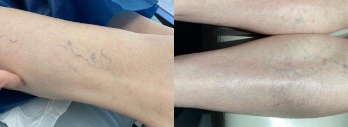 Sclerotherapy & Laser Vein Treatment Case 51 Before & After Right Oblique | Houston, TX | DermSurgery Associates