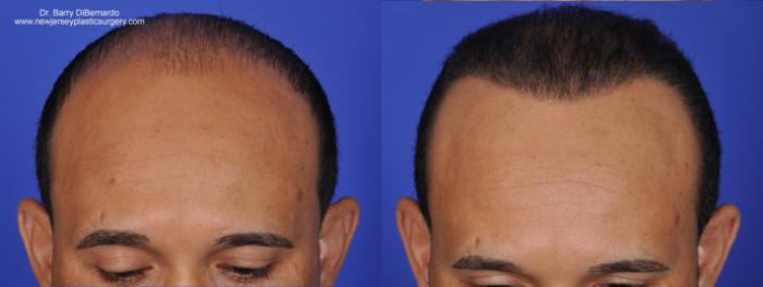 SmartGraft Hair Transplant Case 35 Before & After Front | Houston, TX | DermSurgery Associates