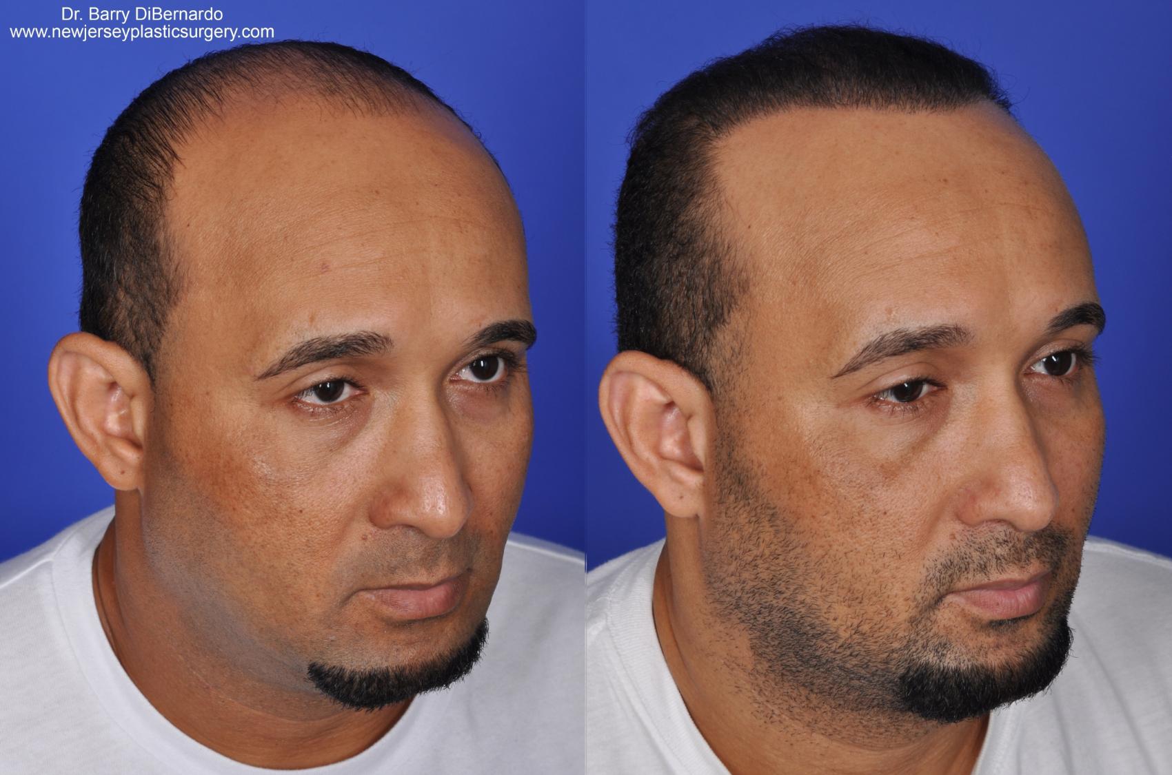 SmartGraft Hair Transplant Before & After Photos Patient 35 | Houston, TX |  DermSurgery Associates