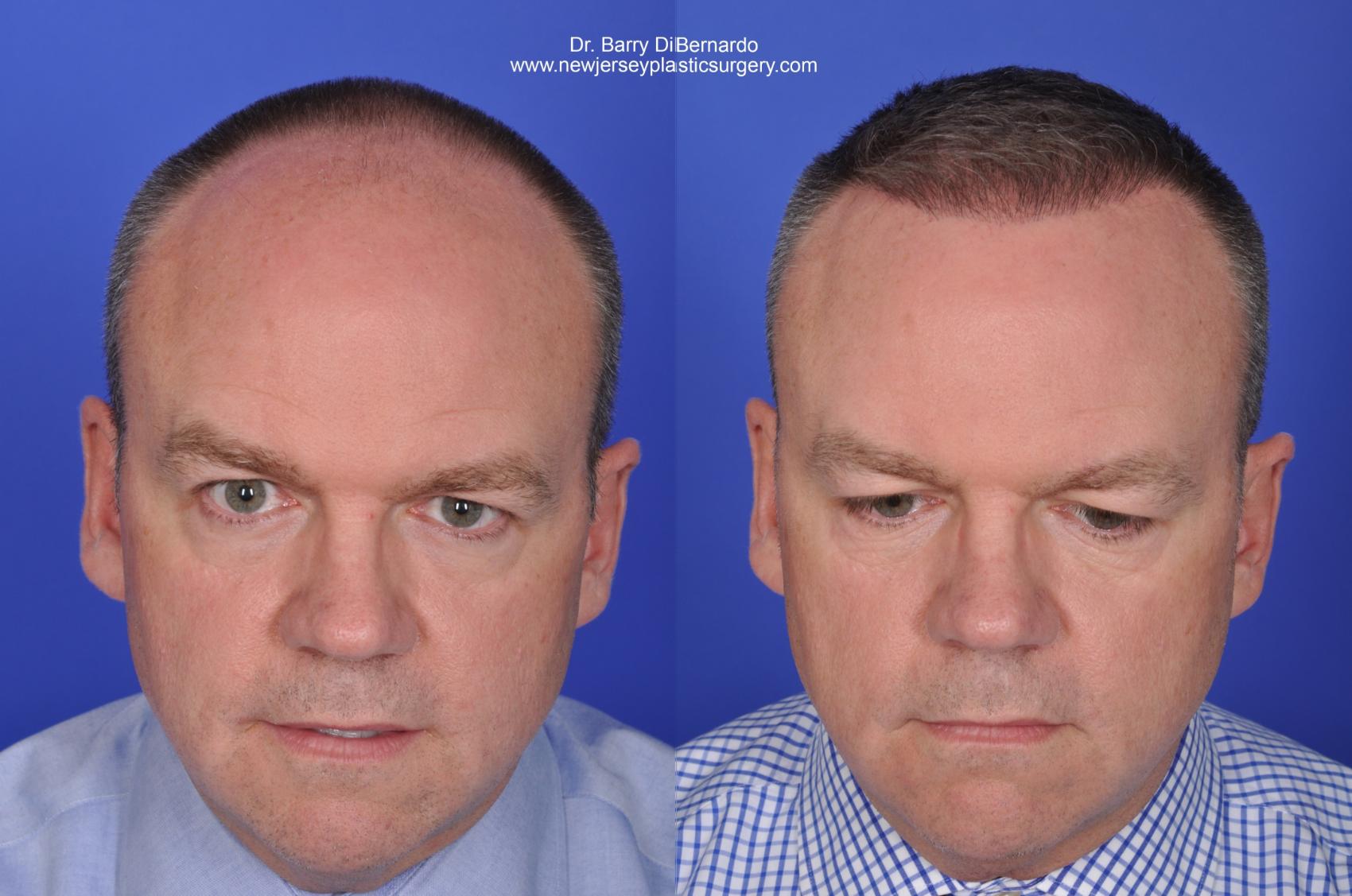 SmartGraft Hair Transplant Before & After Photos Patient 36 | Houston, TX |  DermSurgery Associates