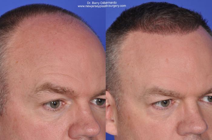 SmartGraft Hair Transplant Case 36 Before & After Right Oblique | Houston, TX | DermSurgery Associates
