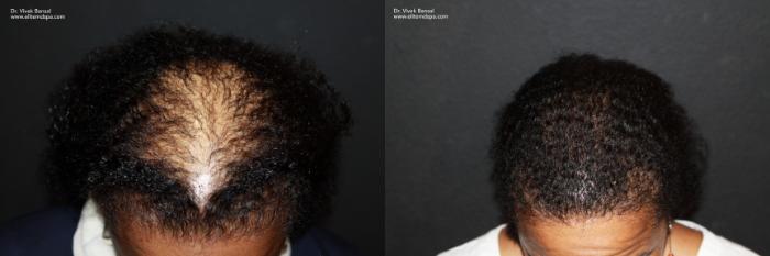 SmartGraft Hair Transplant Case 37 Before & After Top of Head Front | Houston, TX | DermSurgery Associates