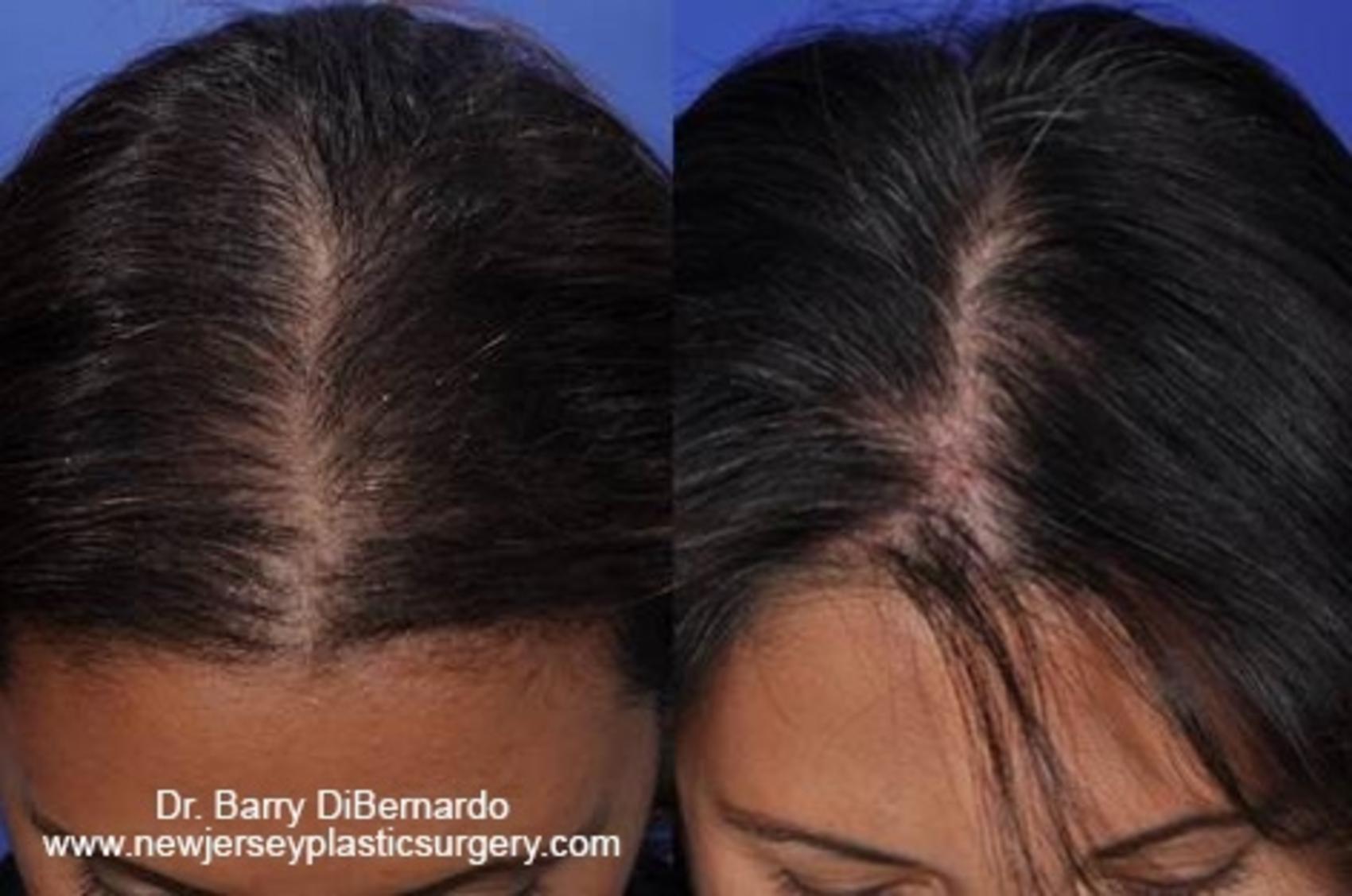 SmartGraft Hair Transplant Case 38 Before & After Top of Head Front | Houston, TX | DermSurgery Associates